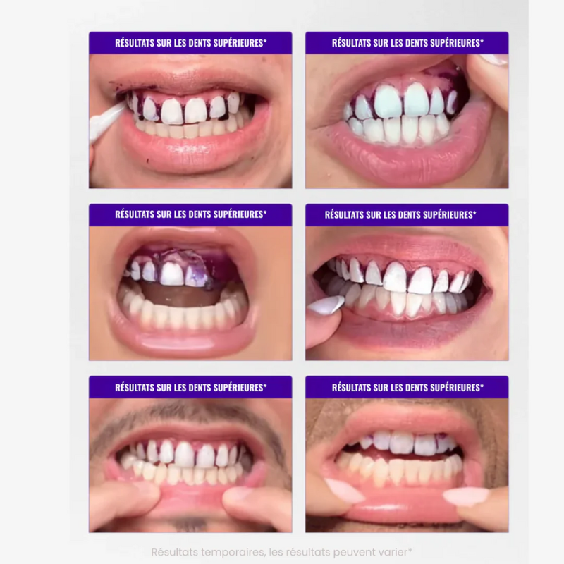Whitening strips 30 min