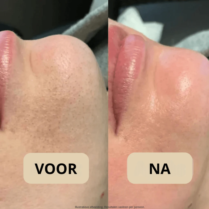 Koreaanse Peel Shot – Onzuiverheden Weg, Stralende Huid